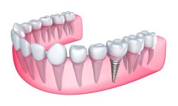 Painless Dental Implants