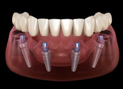 all on 4 & 6 dental implants for same day – full mouth teeth