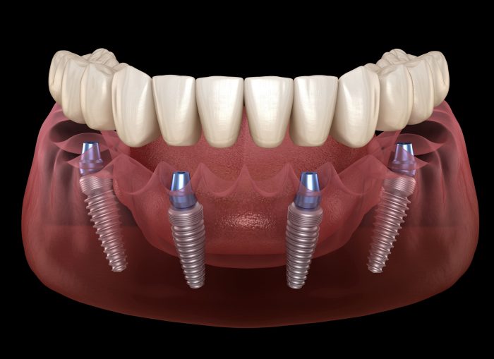 all on 4 & 6 dental implants for same day – full mouth teeth