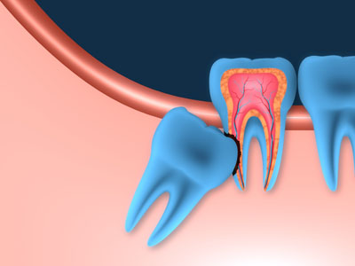 Wisdom Tooth Extraction Near Me | Wisdom Teeth Removal Without Insurance