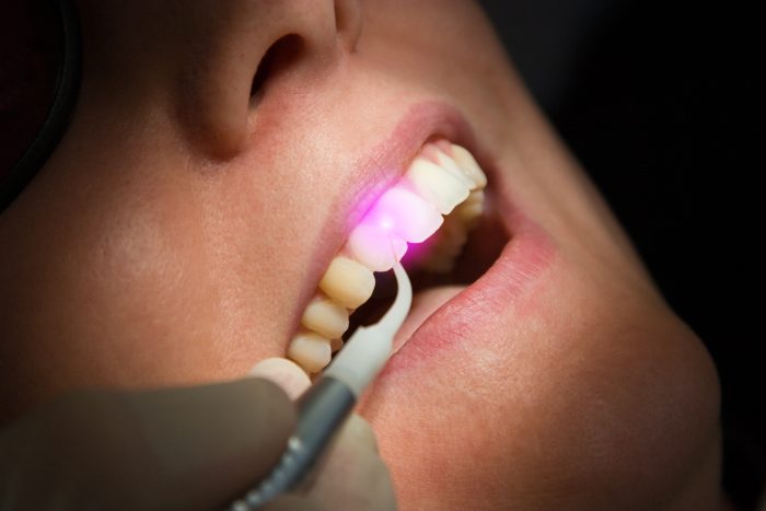 Laser surgery treats gum disease, cold sores,