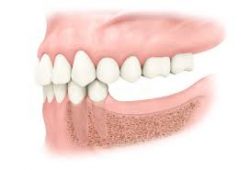 Missing Tooth Implant Near Me