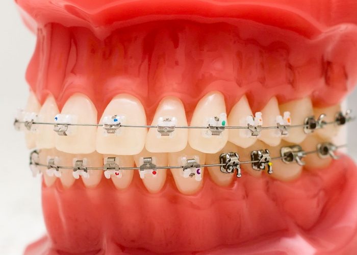 Dental Braces Treatment Cost |Affordable Dental Braces Near Me