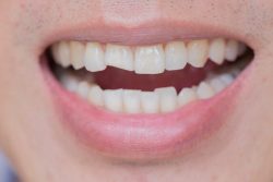 Dental Veneers for Cracked Teeth