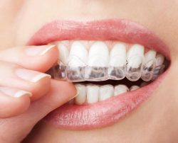 Veneers For Teeth Gap