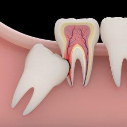 Need An Emergency Wisdom Tooth Removal