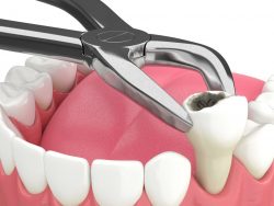 Tooth Extraction Near Me in Houston