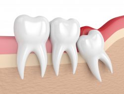 Impacted Wisdom Teeth Removal Near Me | Wisdom Teeth Removal: Procedure & Recovery