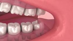 Impacted Wisdom Teeth Removal Near Me |What Will Tooth Extraction Cost?