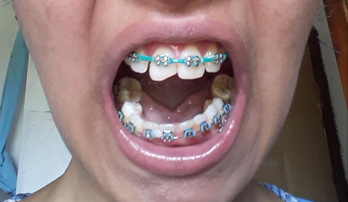 Braces Colors: What Colors are Available and How to Choose |What Are The Best Braces Colors?