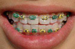 Colored Braces and Bands -Cute Colors For Braces