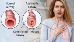 Asthma Natural Treatment