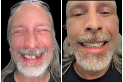 Same Day Dentures Before And After Process