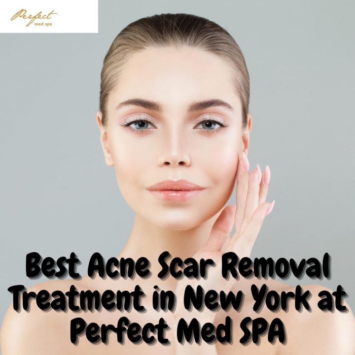 Best Acne Scar Removal Treatment in New York at Perfect Med SPA