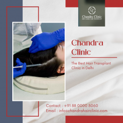 Best Hair Transplant Clinics in Delhi, Pitampura – Chandra Clinic