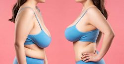 Before and After Breast Lift Surgery | Breast Lift Before And After Photos