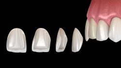 Traditional dental veneers | Dental Veneers: Benefits, Procedure, Costs, and Results