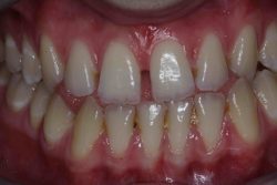 Front Teeth Filling Process | Dentist do front tooth decay repair