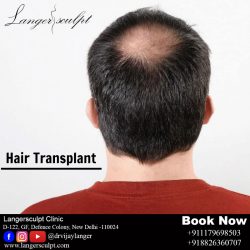Hair Transplant Surgery In Delhi