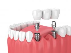 Affordable Dentures And Implants – Edge Dental Houston