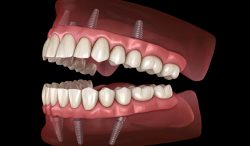 Affordable Full and Partial Dentures Houston, TX – Nu Dentistry