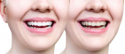 What Is Dental Cosmetic Bonding? | Teeth Bonding: What You Need to Know