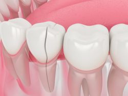 How Much Does a Tooth Filling Cost | Cost of Crooked or Chipped Tooth Treatment