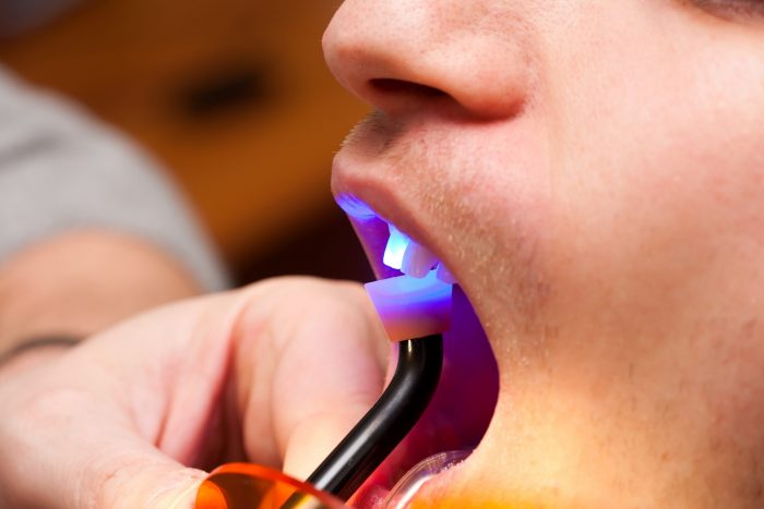 Teeth Bonding in Miami | Dental Bonding Expert