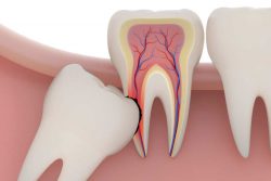 Wisdom Teeth Removal Cost Miami – Wisdom Tooth Extraction