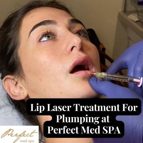 Lip Laser Treatment For Plumping at Perfect Med SPA