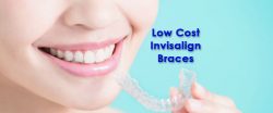 Invisalign Braces Treatment: Get the Perfect Smile at an Affordable Price