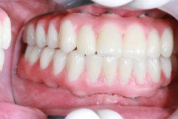 single dental implant treatment at low cost | Affordable Cost Dental Implants