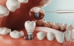 Different Types of Dental Implants | Types of Dental Implants