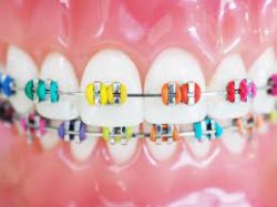 Choosing the best aesthetic for your braces band colors