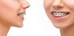Overbite Before And After Braces |Overbite Before And After Braces
