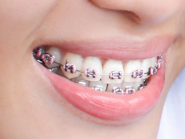 Braces Colours: How To Choose Your Perfect Shade