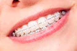 Different Color Braces For Teeth |What are the Best Braces Color