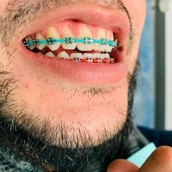 How to Choose the Best Braces Colors to Brighten Your Smile