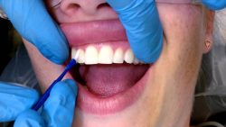Dental Health and Fluoride Treatment – Fluoride Treatment For Teeth