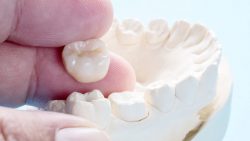 What’s The Best Crown For Your Tooth?