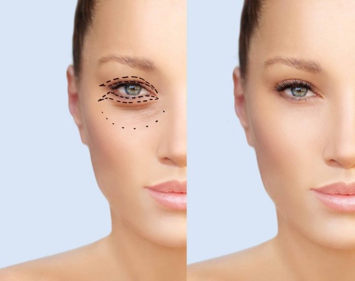 How Much Does Eye Lift Surgery Cost? | Blepharoplasty Cost in India | Blepharoplasty Eyelid Surgery