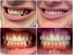 Same Day Dental Crowns Near Me | Benefits and Drawbacks of Same Day Dental Crowns