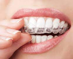 How Much Do Clear Braces Cost? |Clear Teeth Aligners, Invisible Braces Cost