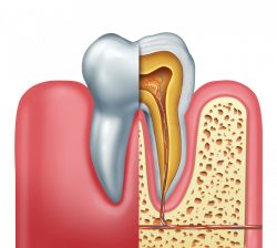 Root Canal in Houston, TX | Affordable Root Canal Treatment In Houston, TX