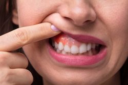 Oral Cancer Screening | Oral Cancer Symptoms & Signs