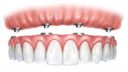 What Are Dental Implants for Dentures? | Dental implant surgery
