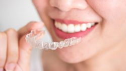 How Much Do Clear Braces Cost? | What is the Cost of Invisible Braces?