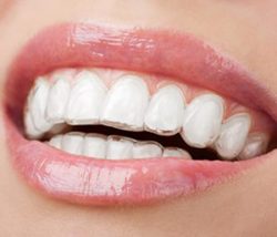 How Much Do Clear Braces Cost? | Clear Braces Cost Guide