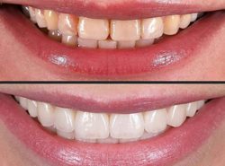 What Are The Different Types Of Veneers | Different types of veneers and their applications R ...