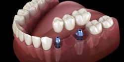Dental Implant Specialist Near Me | Best Dentist for Dental Implants